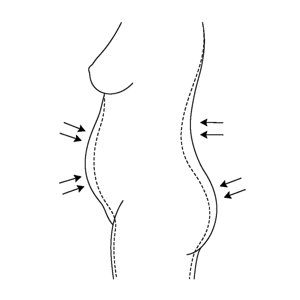 360° Liposuction