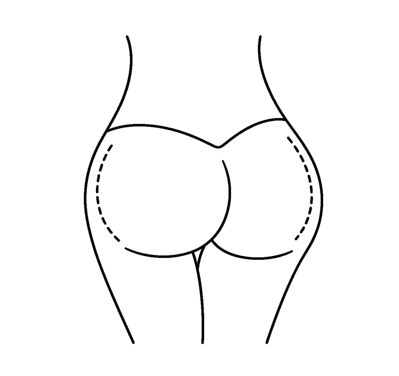 Buttock (Gluteal) Augmentation