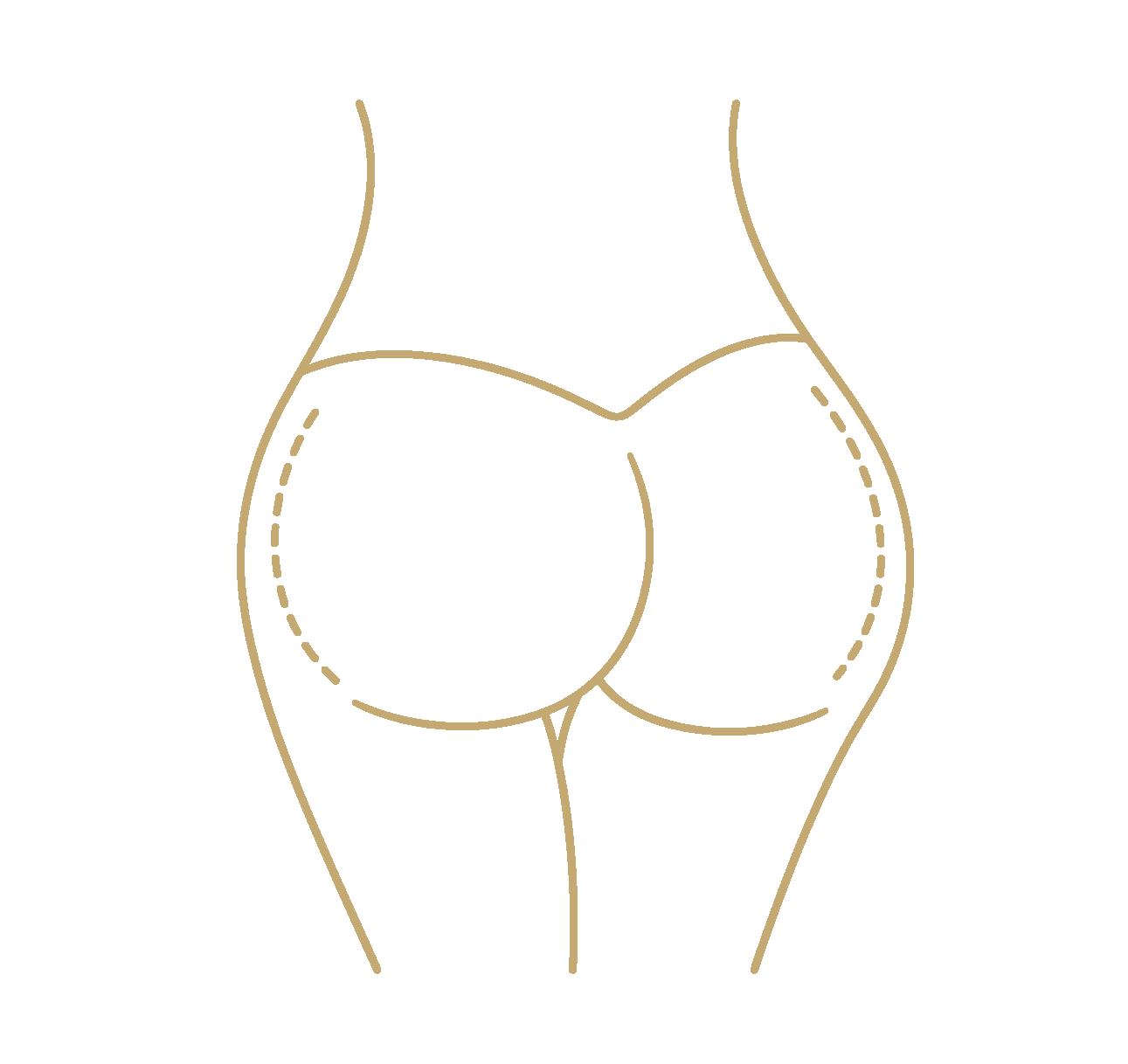 Buttock (Gluteal) Augmentation - procedure illustration