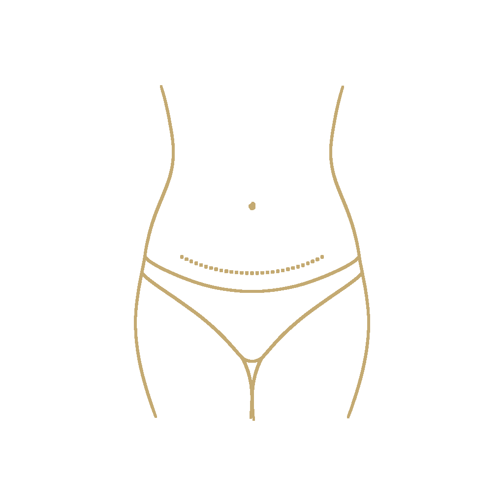 Lower Body Lift (Belt Lipectomy) - procedure illustration