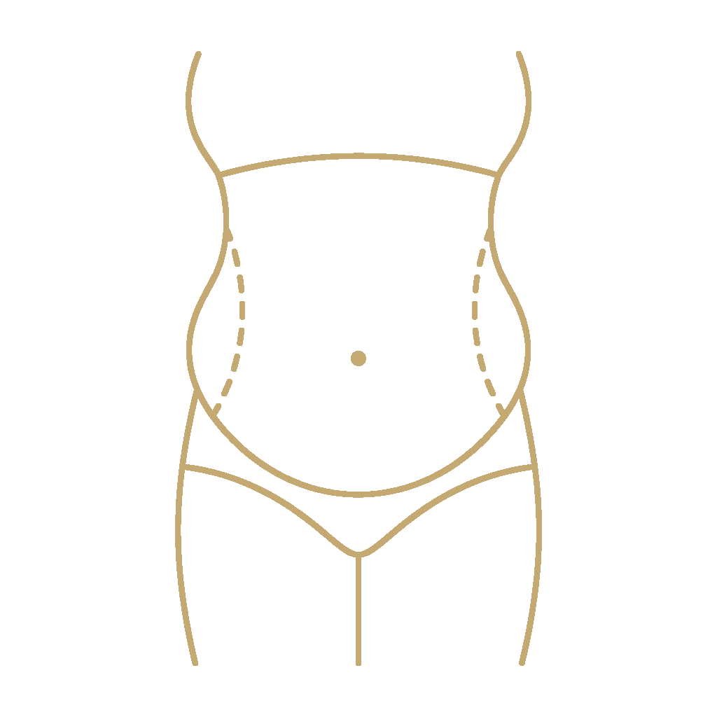 Tummy Tuck (Abdominoplasty) - procedure illustration