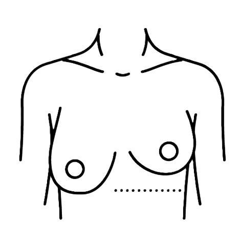 Breast Asymmetry Correction