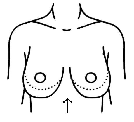 Breast Lift (Mastopexy)