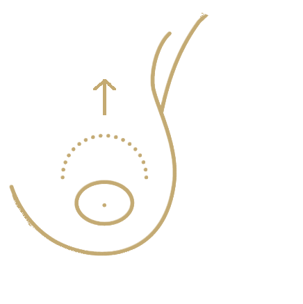 Nipple & Areola Correction - procedure illustration