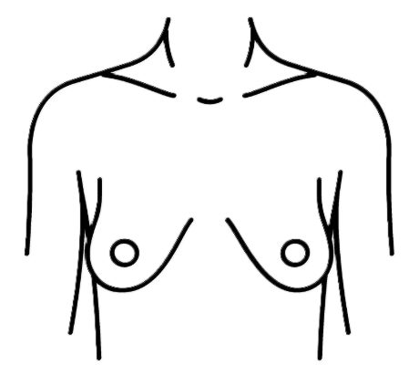 Tuberous Breast Correction